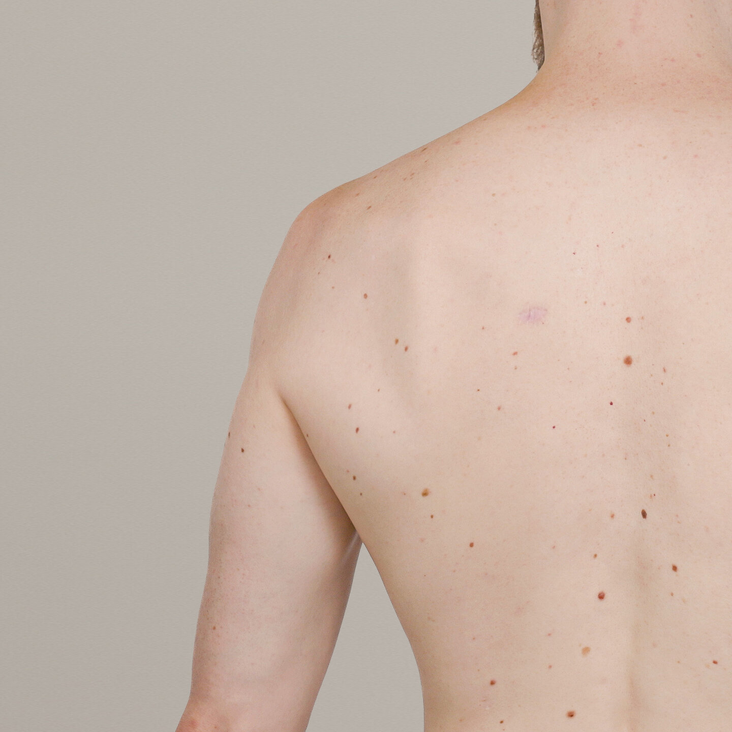 Rückenaufnahme eines Patienten mit dem ATBM master zur Hautdokumentation.