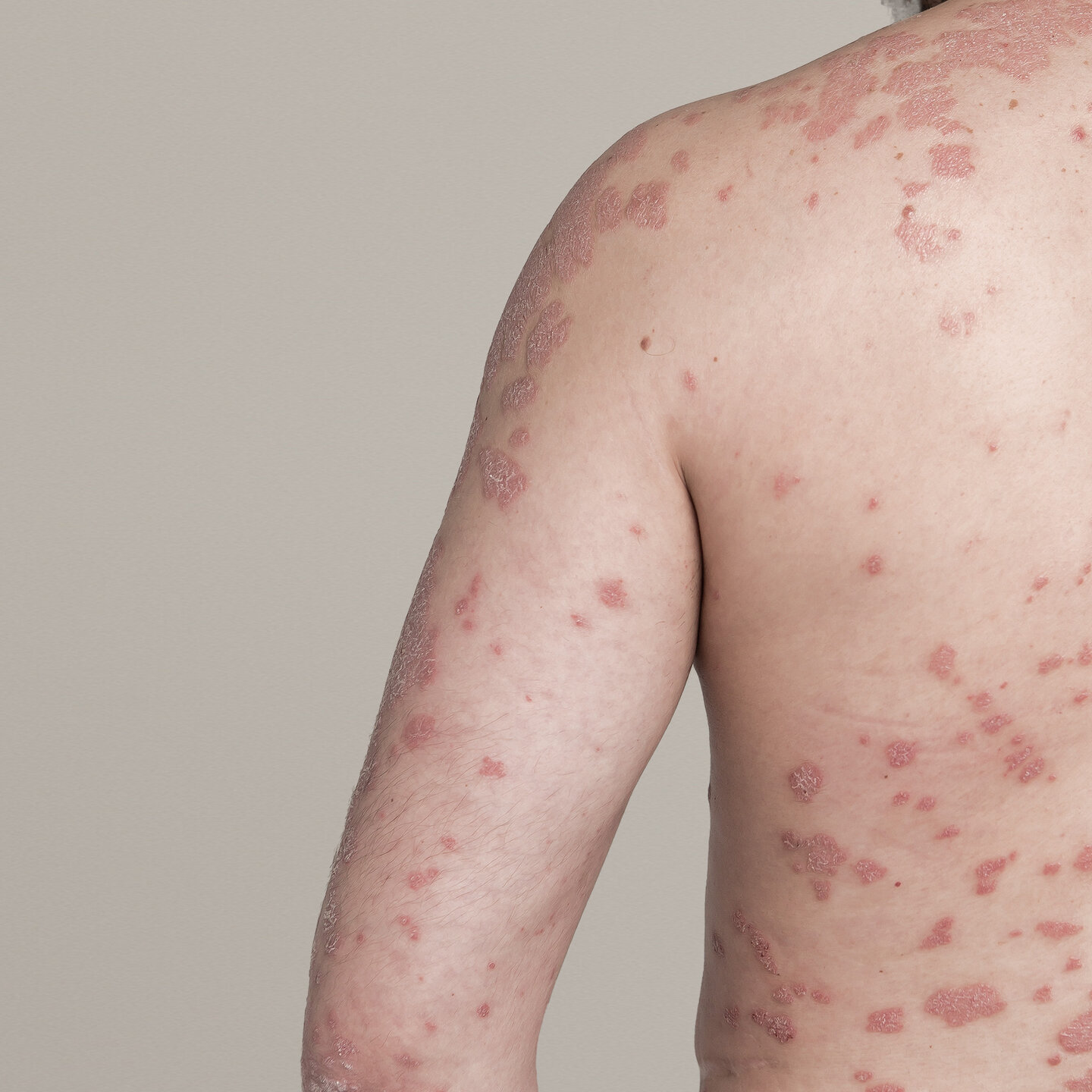 Klinische Rückenaufnahme eines Patienten mit Psoriasis zur standardisierten Dokumentation.