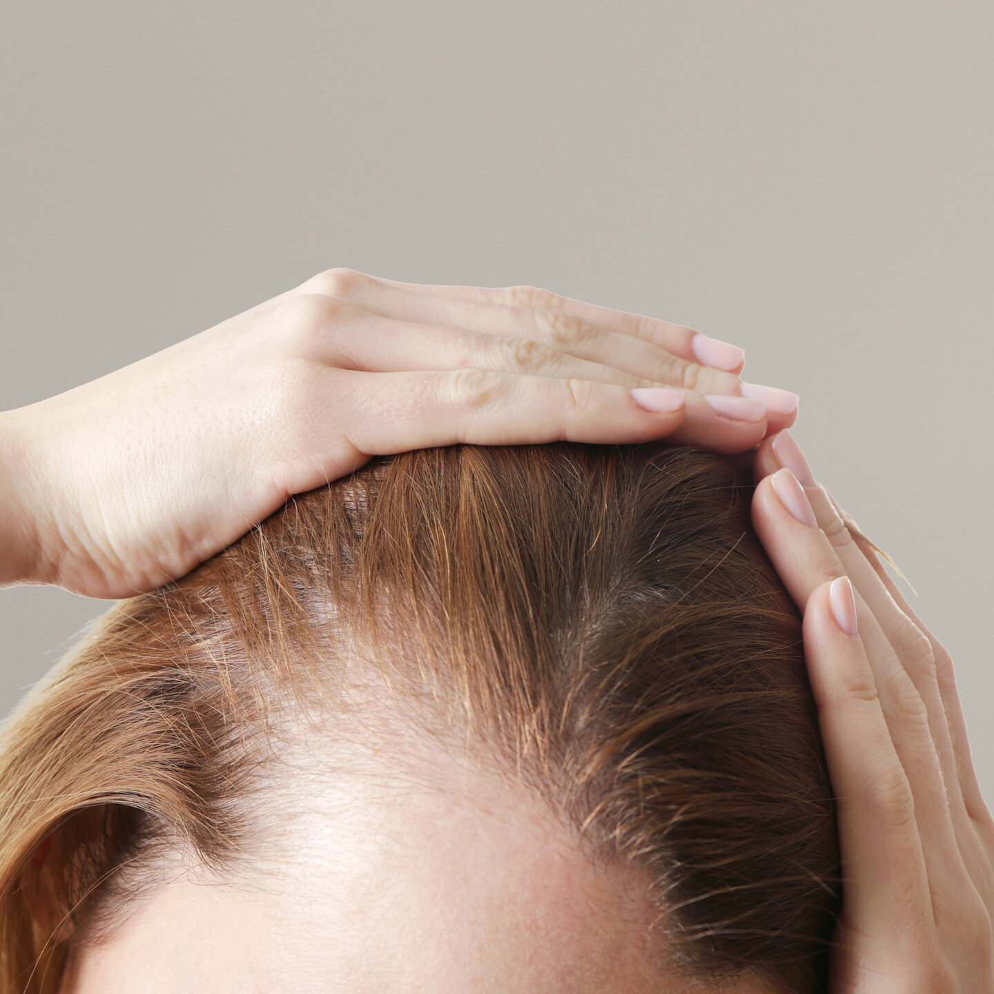 Nahaufnahme des Haaransatzes einer Patientin zur trichoskopischen Beurteilung von Alopezie.