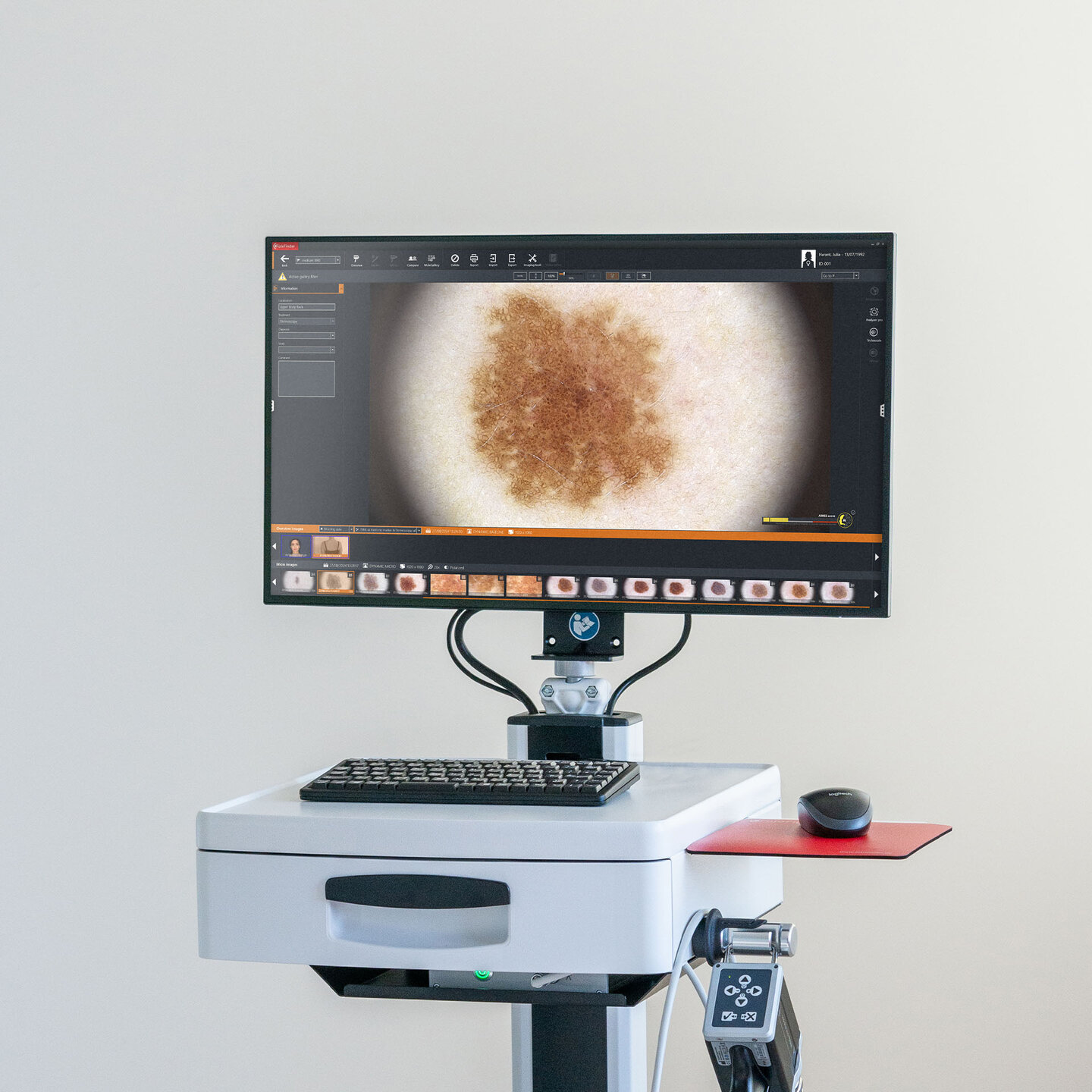 Monitor des FotoFinder vexia mit dermatoskopischer Aufnahme eines Muttermals
