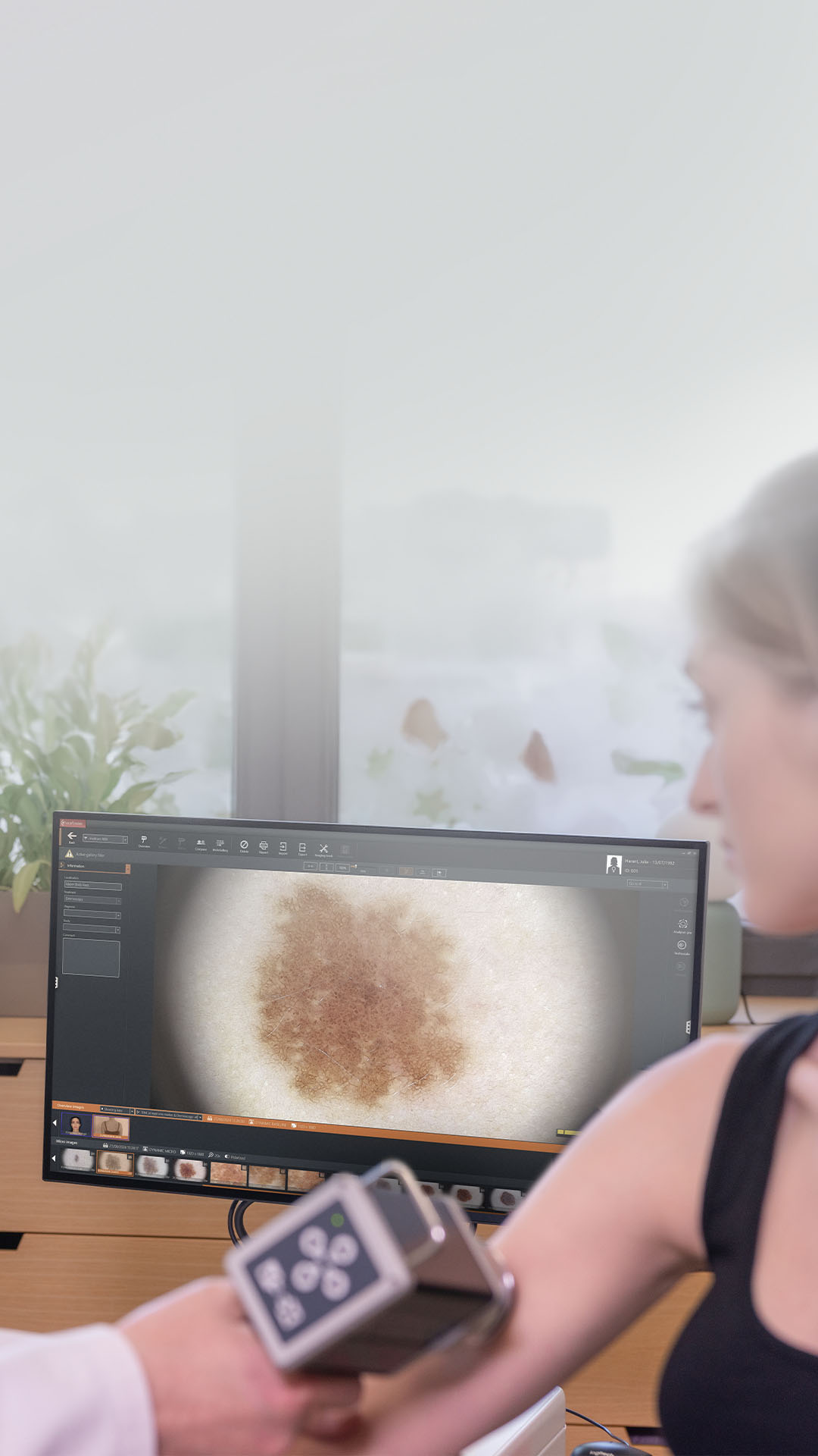 Dermatoskopische Untersuchung eines Muttermals mit der medicam 1000s und dem vexia-System.