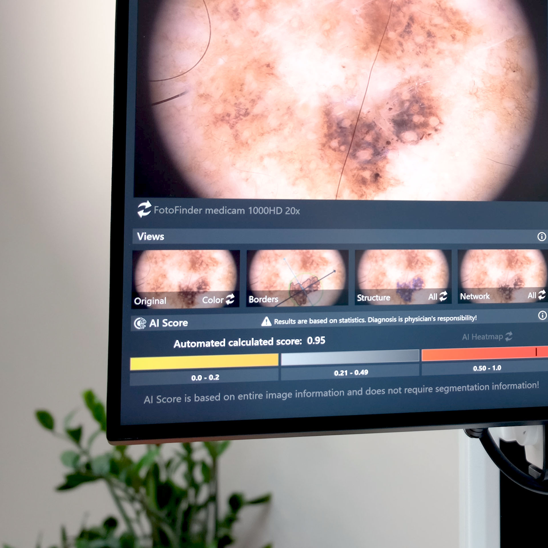 Monitoransicht einer Hautläsion mit KI-gestützter Auswertung im FotoFinder medicam System
