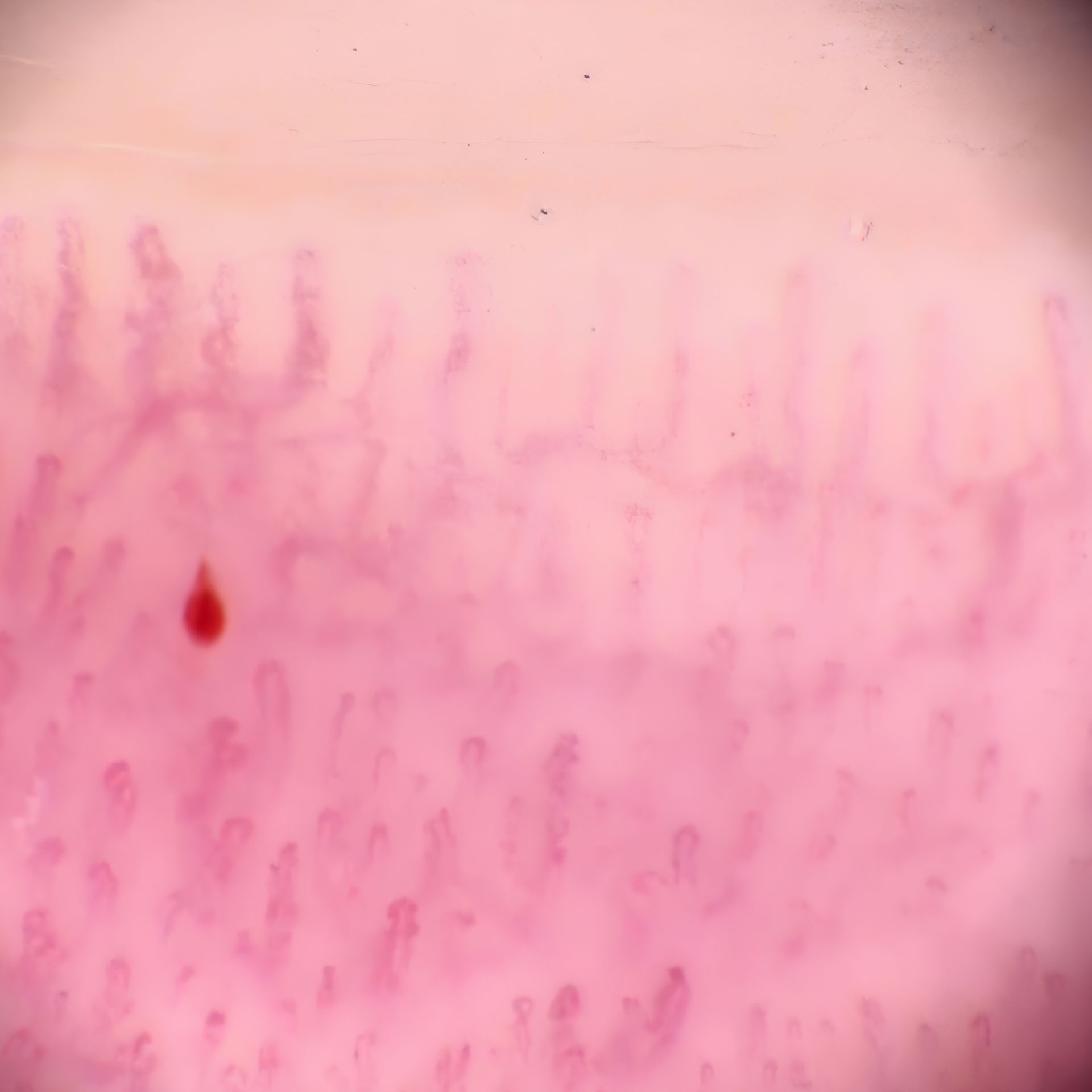 Kapillaroskopische Aufnahme von Kapillaren in der Nagelfalz mit dem FotoFinder medicam System