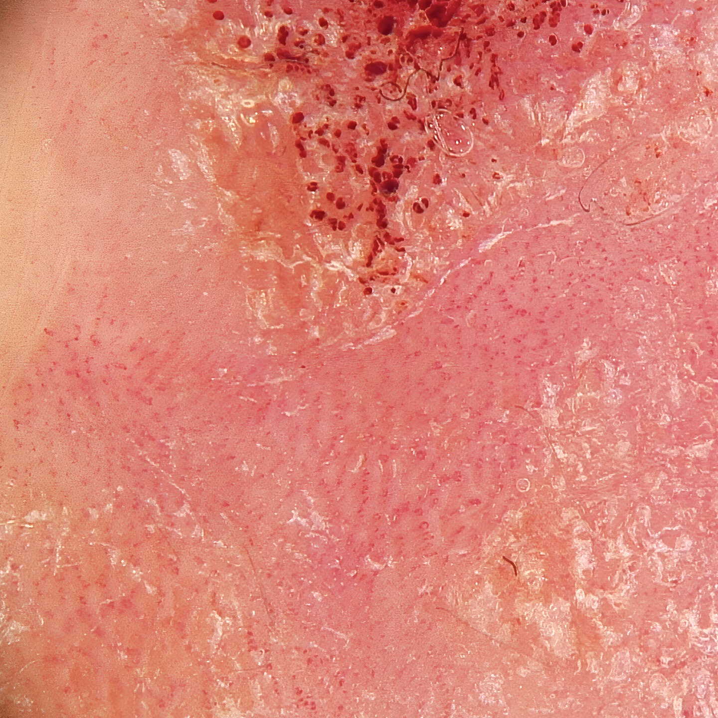 Dermatoskopische Aufnahme einer entzündlichen Hautveränderung