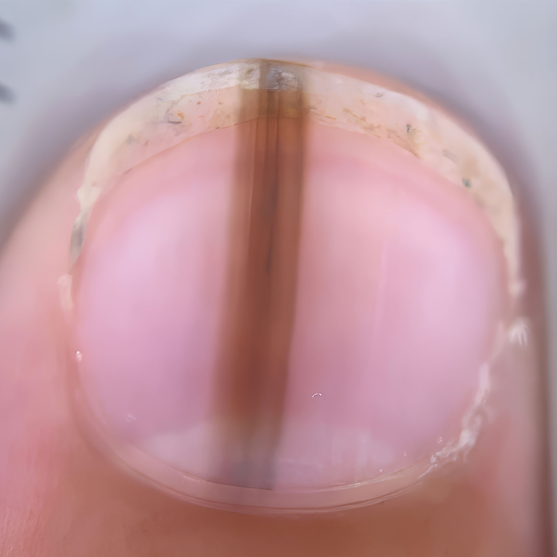 Nagelveränderung unter der medicam im polarisierten Licht