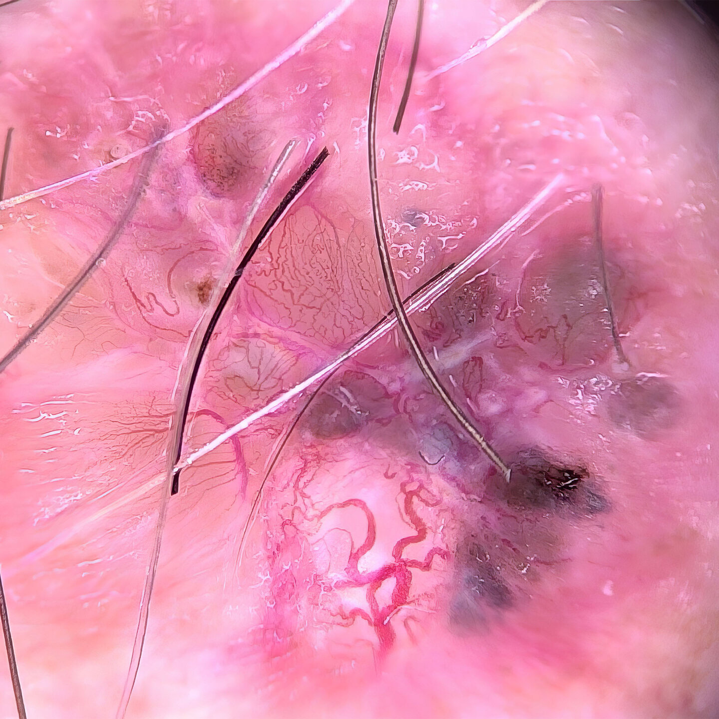 Dermatoskopische Aufnahme in hoher Vergrößerung mit feinen Strukturen und Gefäßen auf rosafarbener Haut