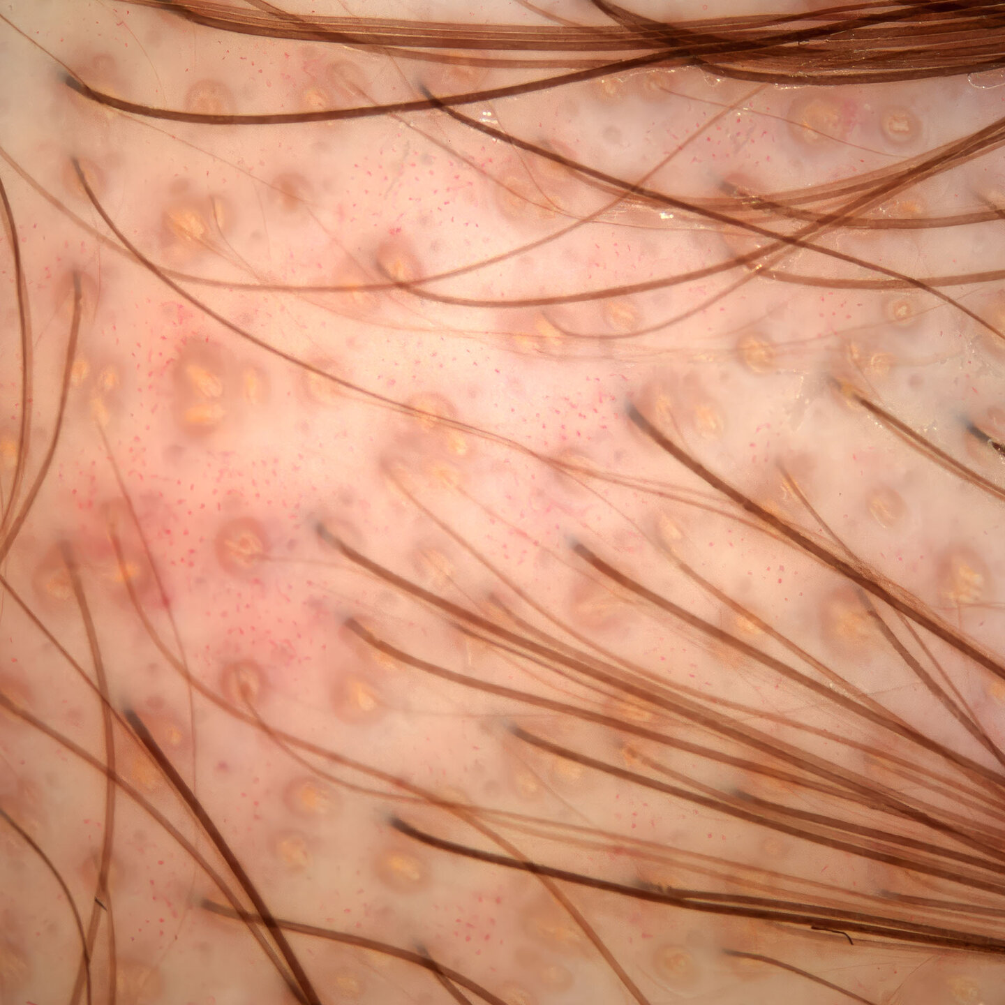 Trichoskopie-Aufnahme der Kopfhaut mit Haarfollikeln