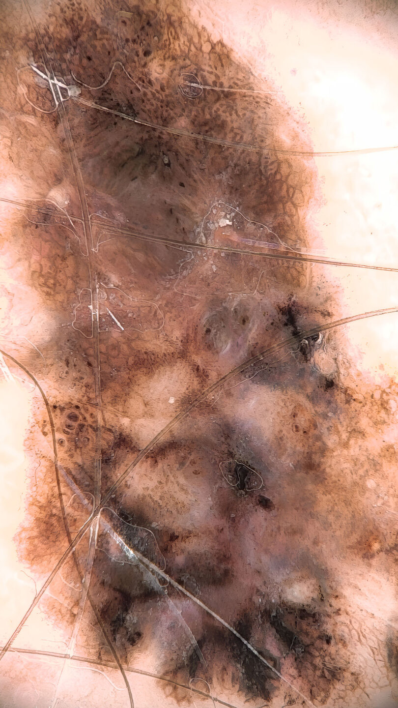 Hautstrukturaufnahme mit der FotoFinder medicam ultra high