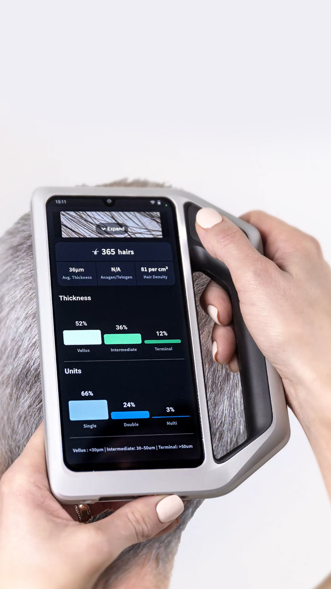 Trichoskopie mit Smartphone und skeen App