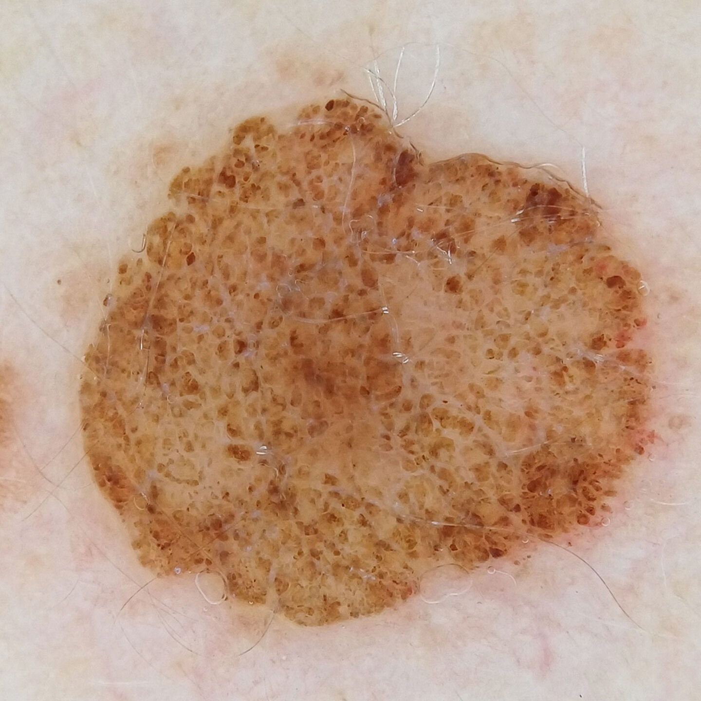 Dermatoscopic close-up of a pigmented skin lesion with skeen