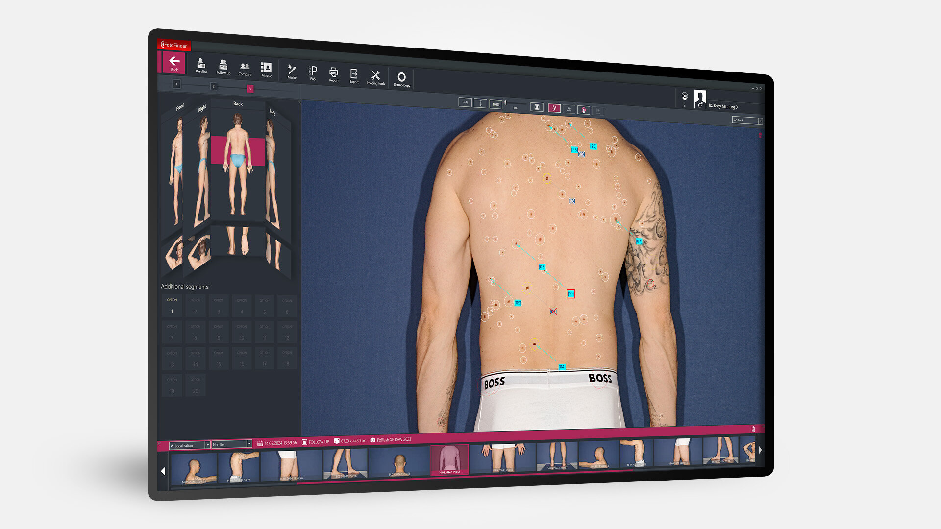 Screen with FotoFinder bodystudio