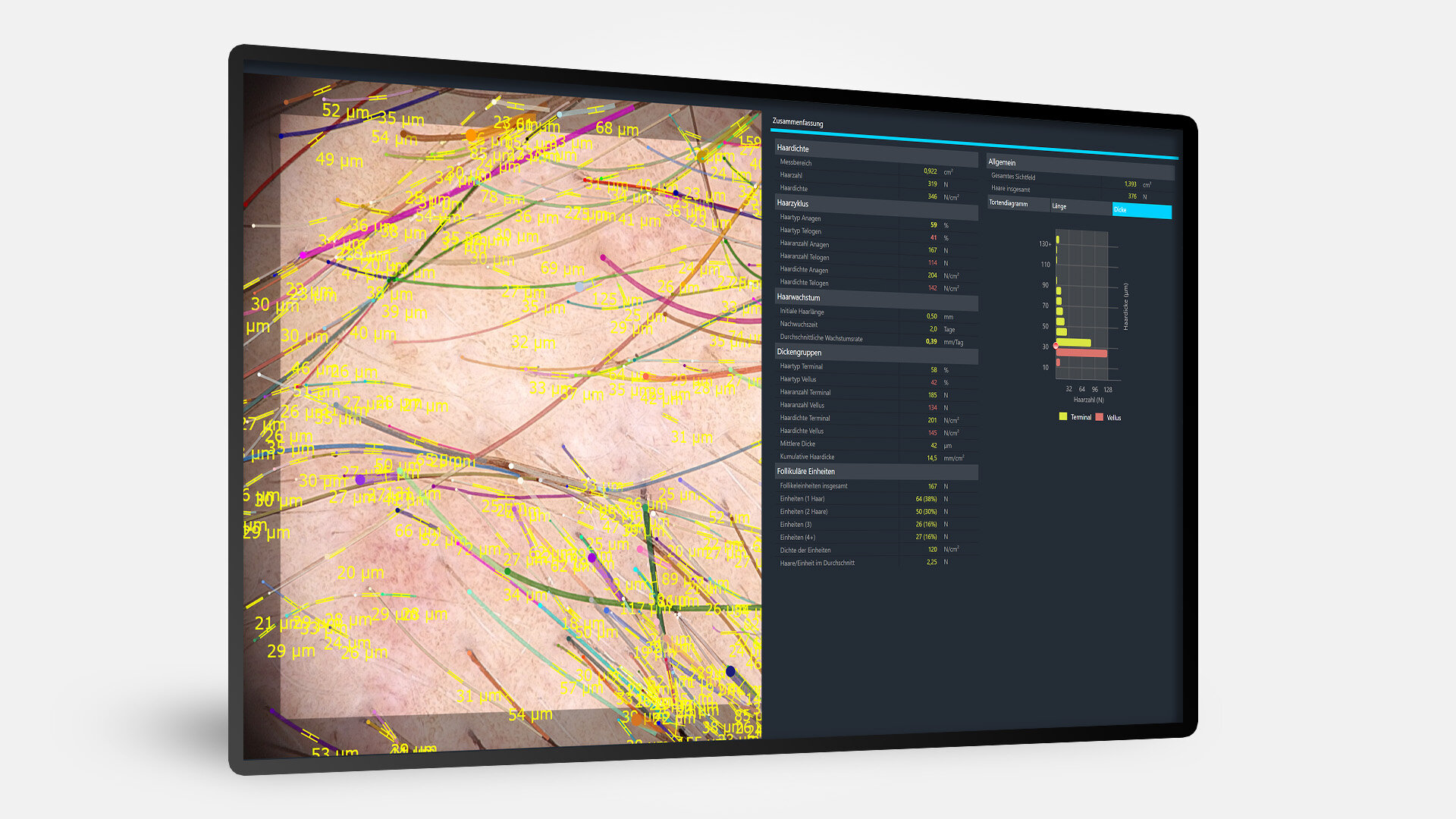 Bildschirm mit Trichoscale DX und Analyse der Haardicke