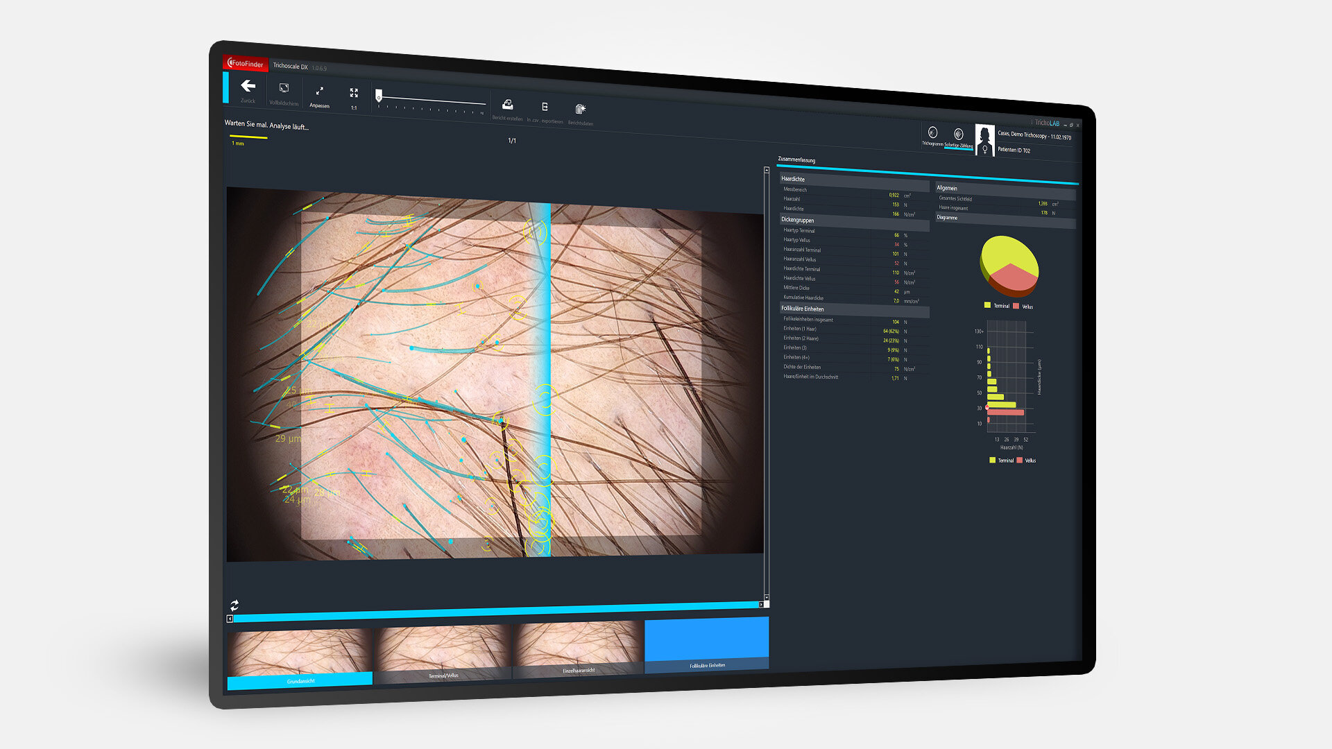 Bildschirm mit Trichoscale DX und Instant Count