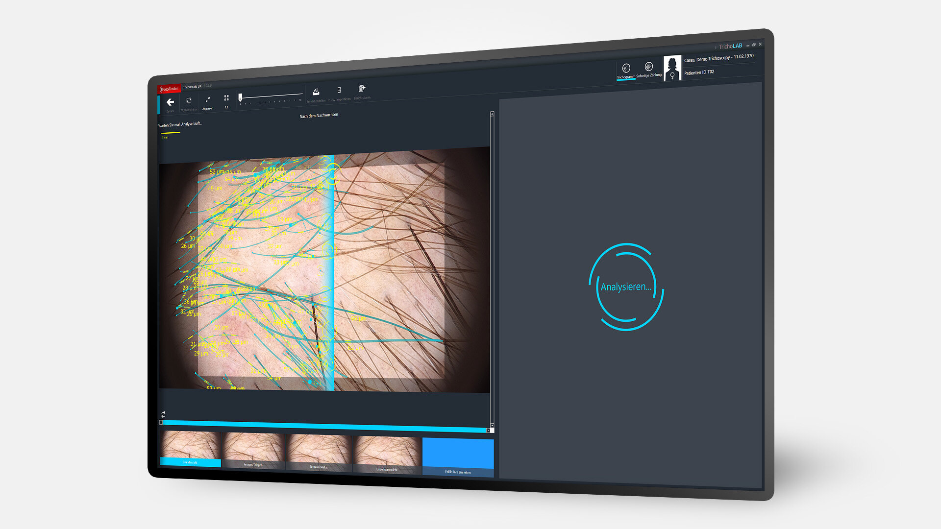 Bildschirm mit Trichoscale DX und Trichogram