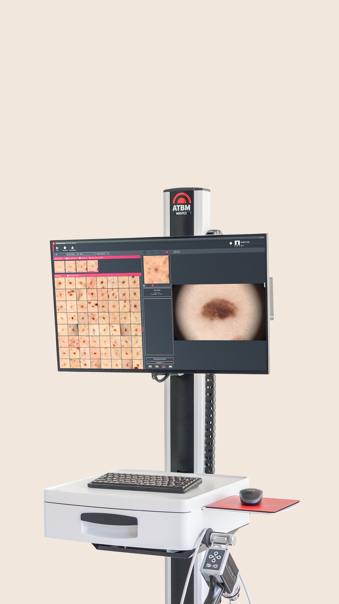 Melanoma follow-up on the ATBM master – comparison of sequential images.