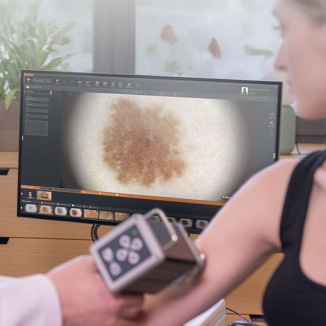 Dermatoskopische Untersuchung eines Muttermals mit der medicam 1000s und dem vexia-System.