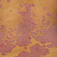 Psoriasis Documentation