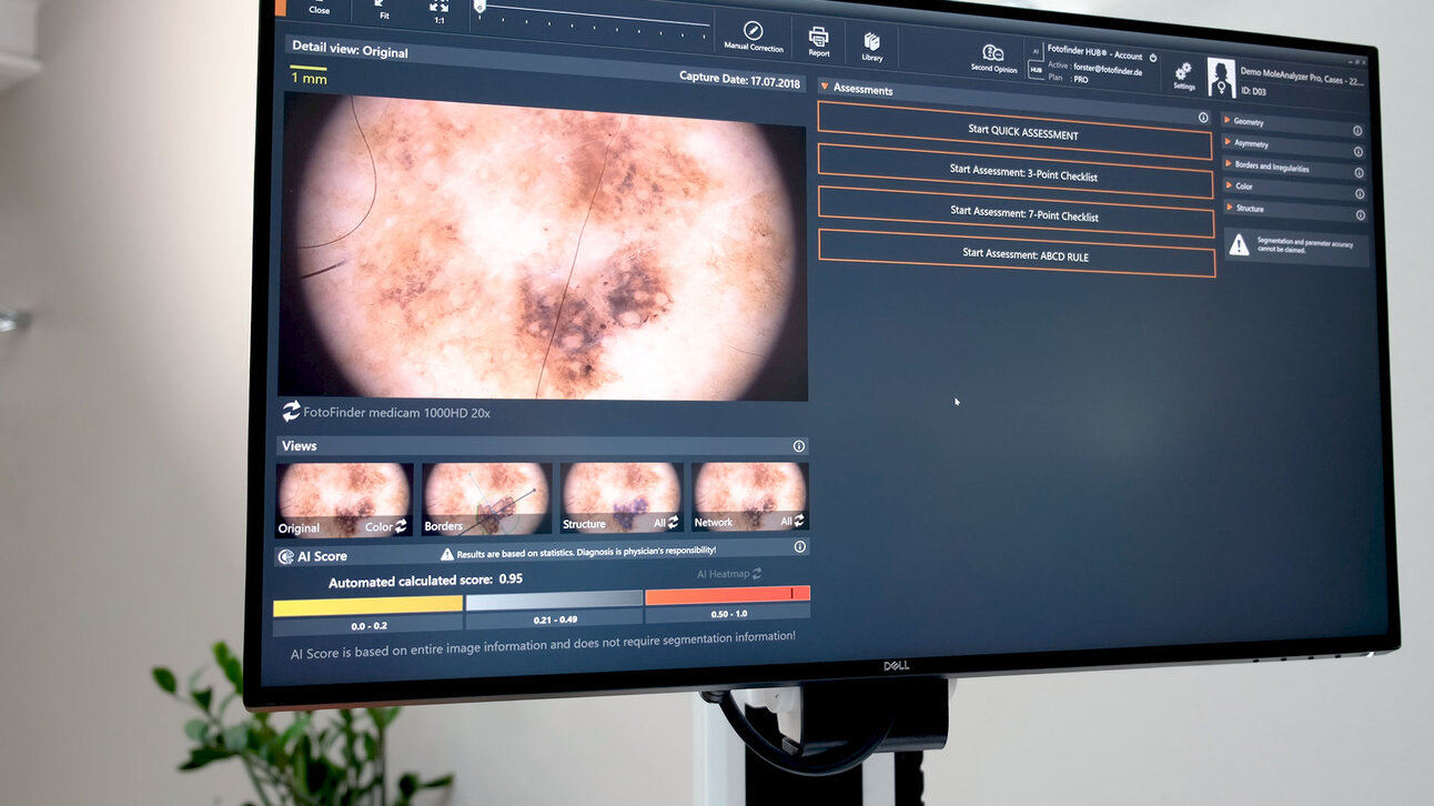 Monitoransicht mit KI-Auswertung einer Hautläsion im FotoFinder medicam System