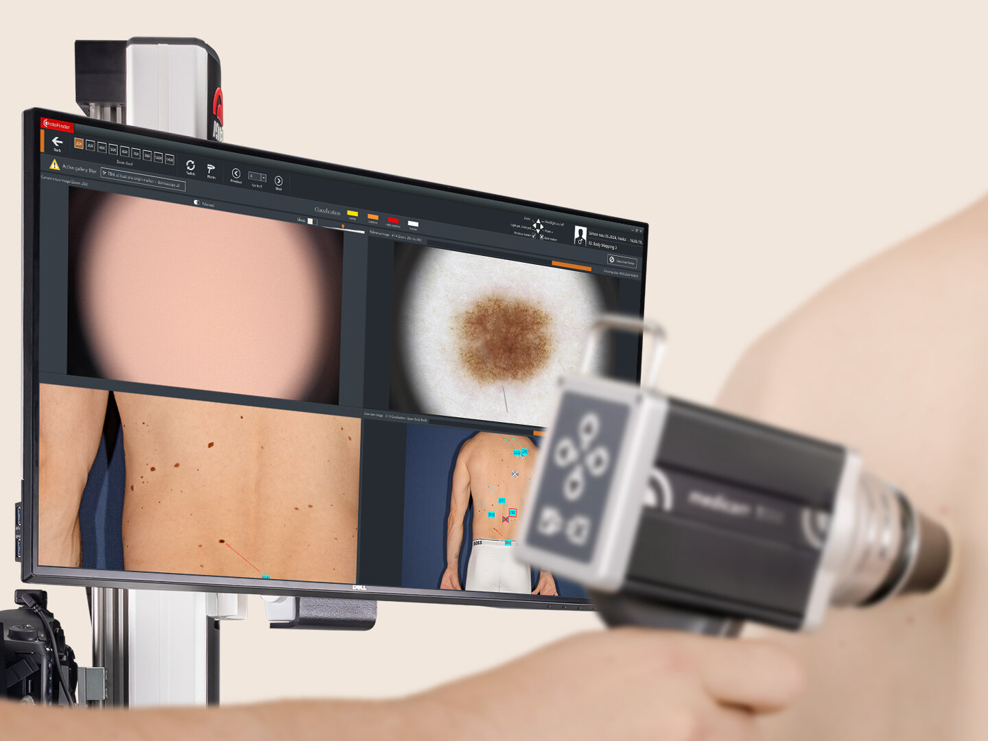 Digital close-up of a mole with a modern dermatoscope medicam 1000s – every detail matters.