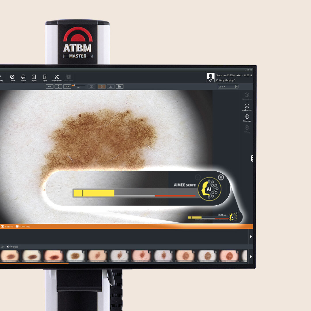 Dermatoskopie-Software Moleanalyzer Pro mit AI-Score