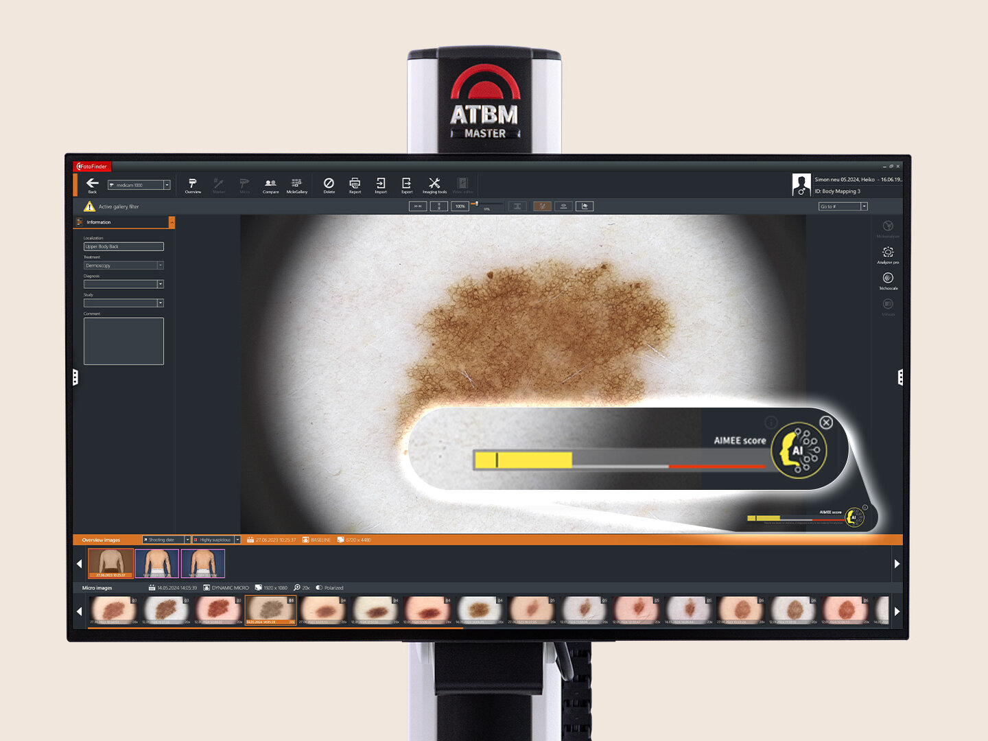 Dermoscopy Software Moleanalyzer Pro including AI software 