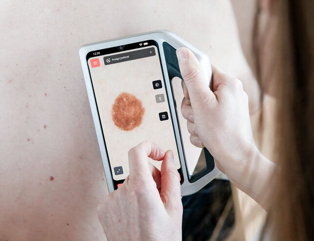 Dermatoskopische Aufnahme mit dem skeen Gerät auf der Schulter