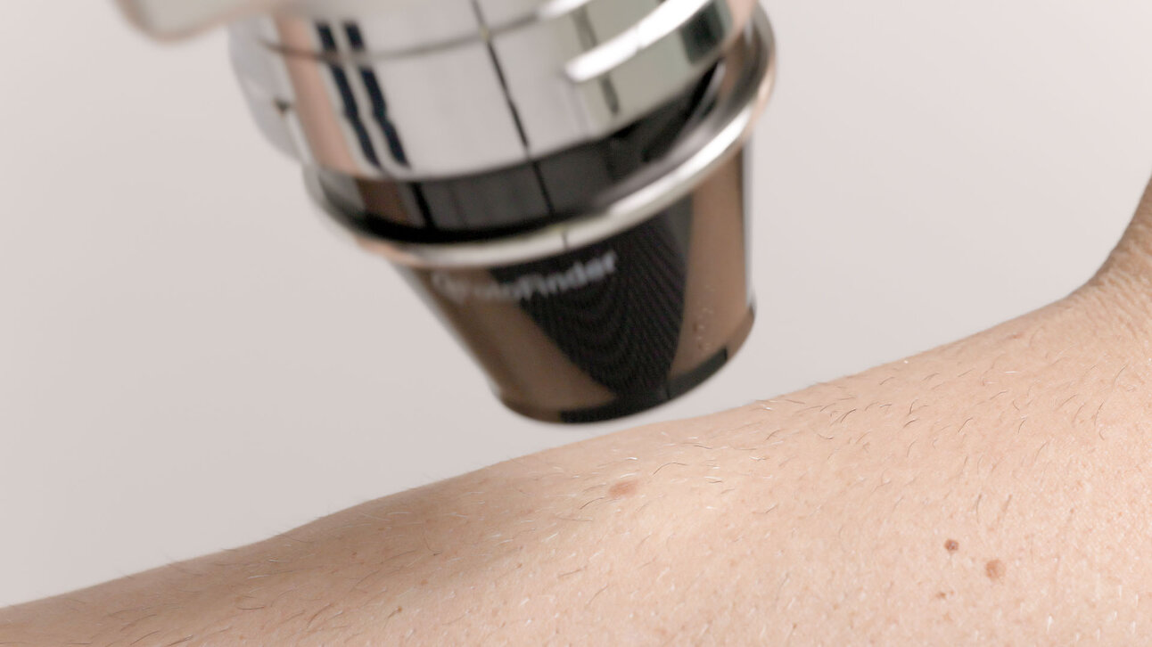 Nahaufnahme der medicam 1000s bei der Positionierung über einer Hautstelle.