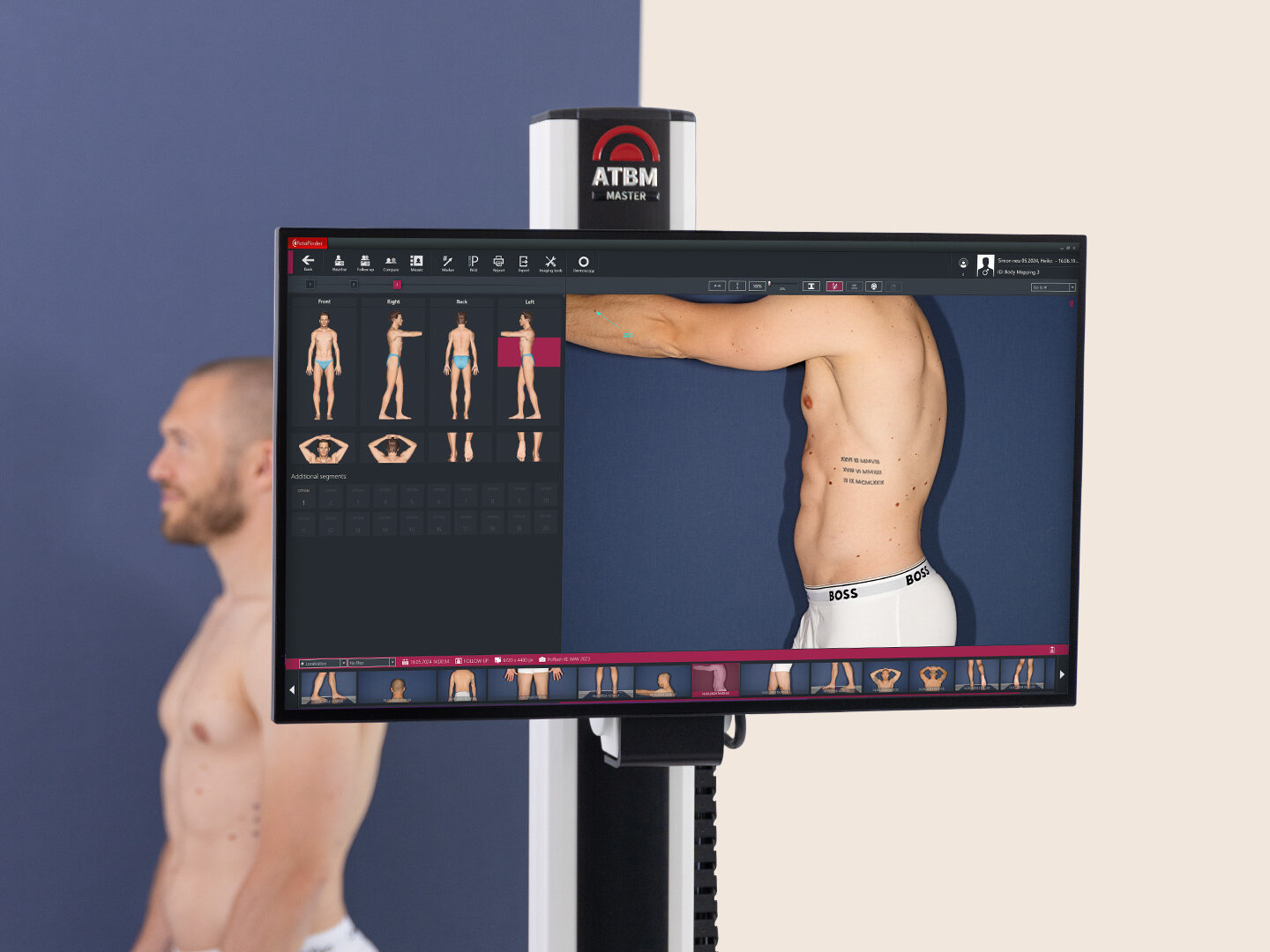 Automated total body mapping of a patient – high-resolution full-body image on the screen.