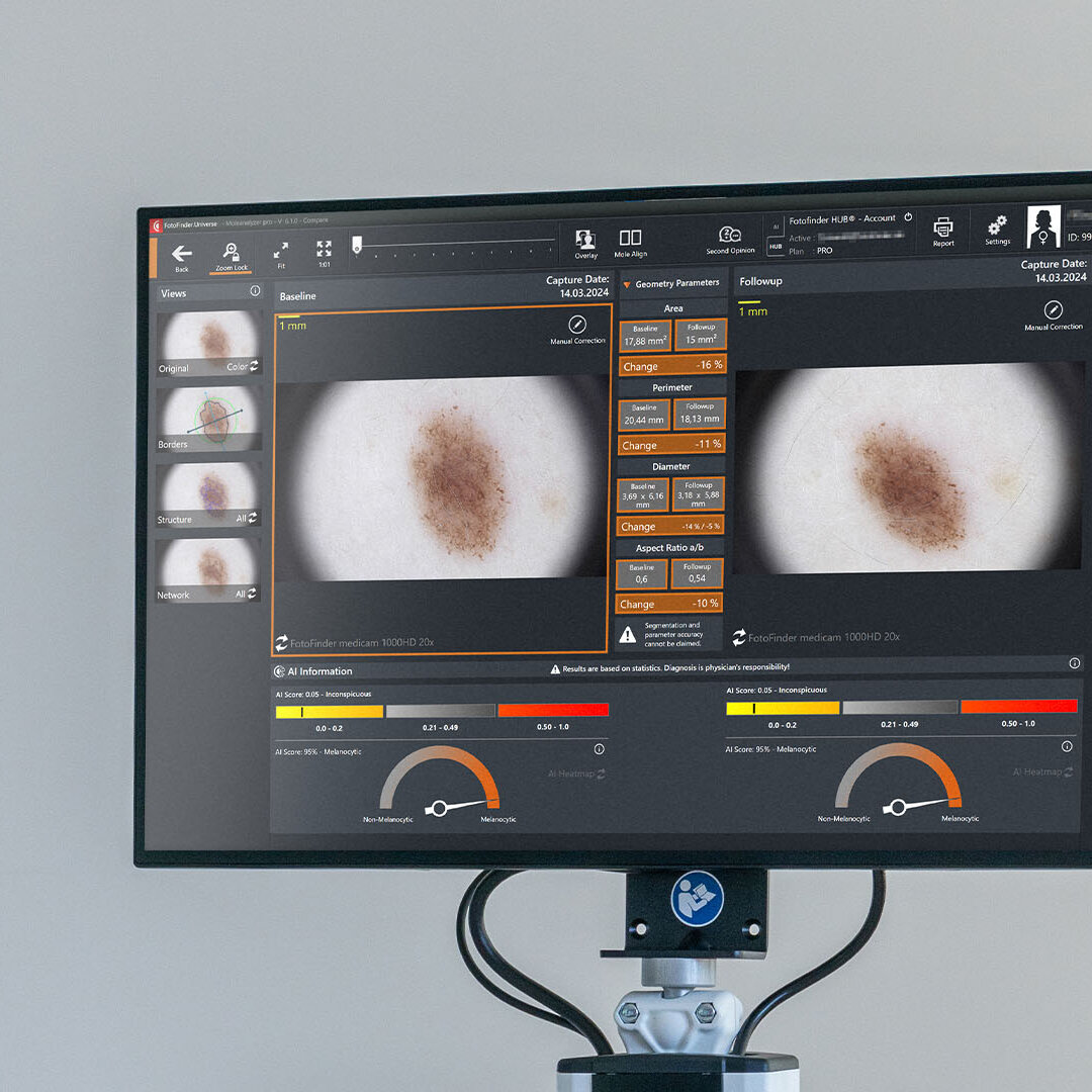 Monitor view of FotoFinder vexia showing two dermoscopic images and analysis results