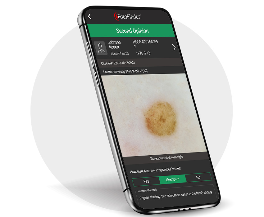 [Translate to English:] FotoFinder Systems, FotoFinder AI, Handyscope pro, Second Opinion, Zweitmeinung