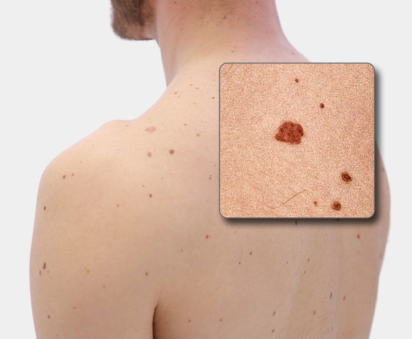 ATBM master 4th Gen: Unveiling dermoscopic structures in the clinical image