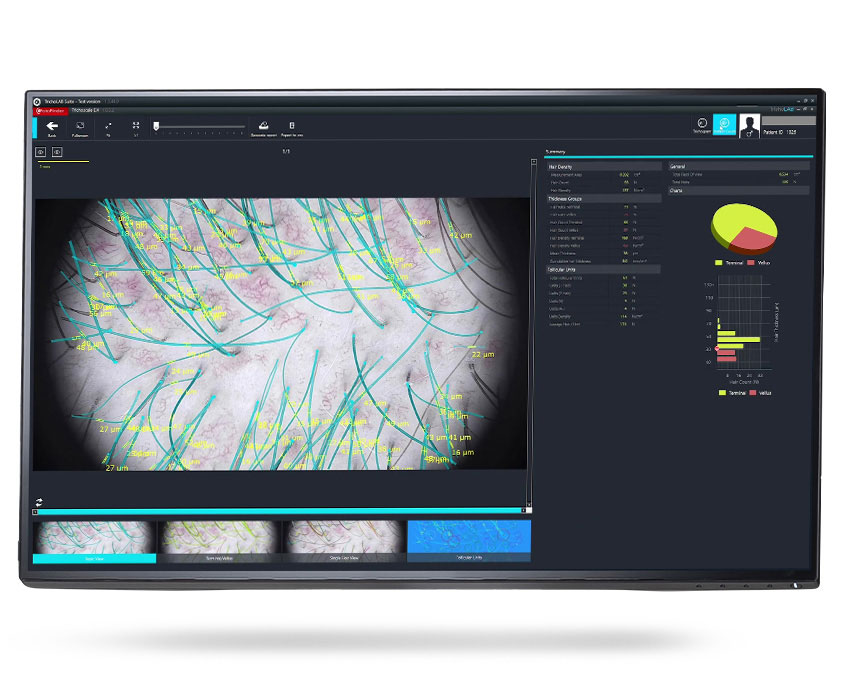 FotoFinder Systems, Trichoscale DX