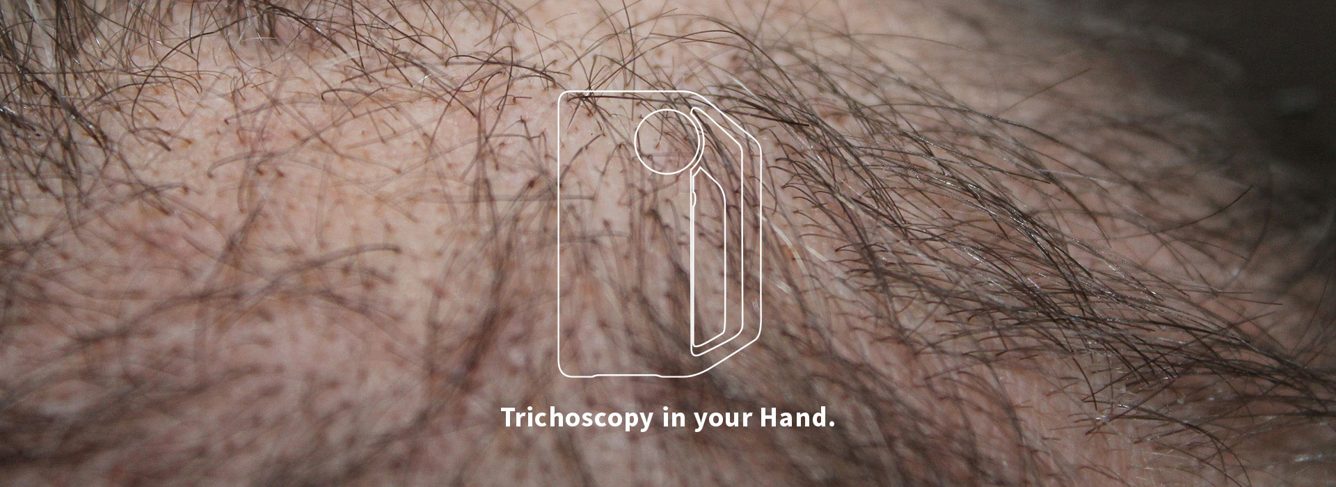 skeen for Trichoscopy