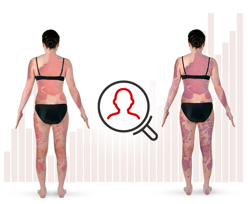 FotoFinder Systems PASIvision clinical trial